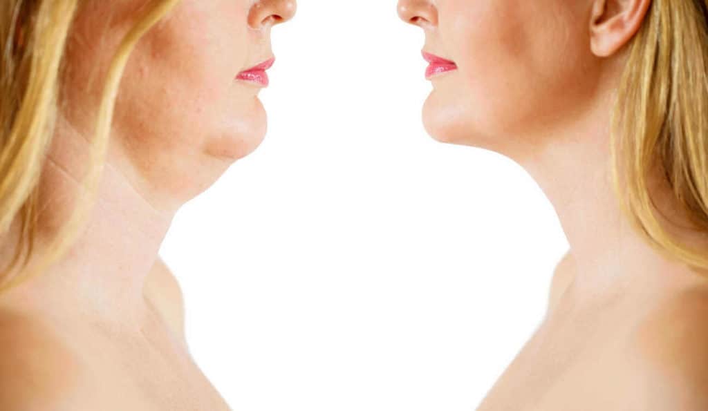 Double Chin treatment Neasden before and after results