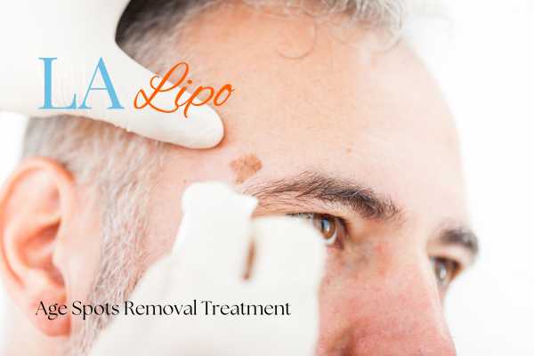 What Are the Most Effective Treatments for Age Spots Neasden?