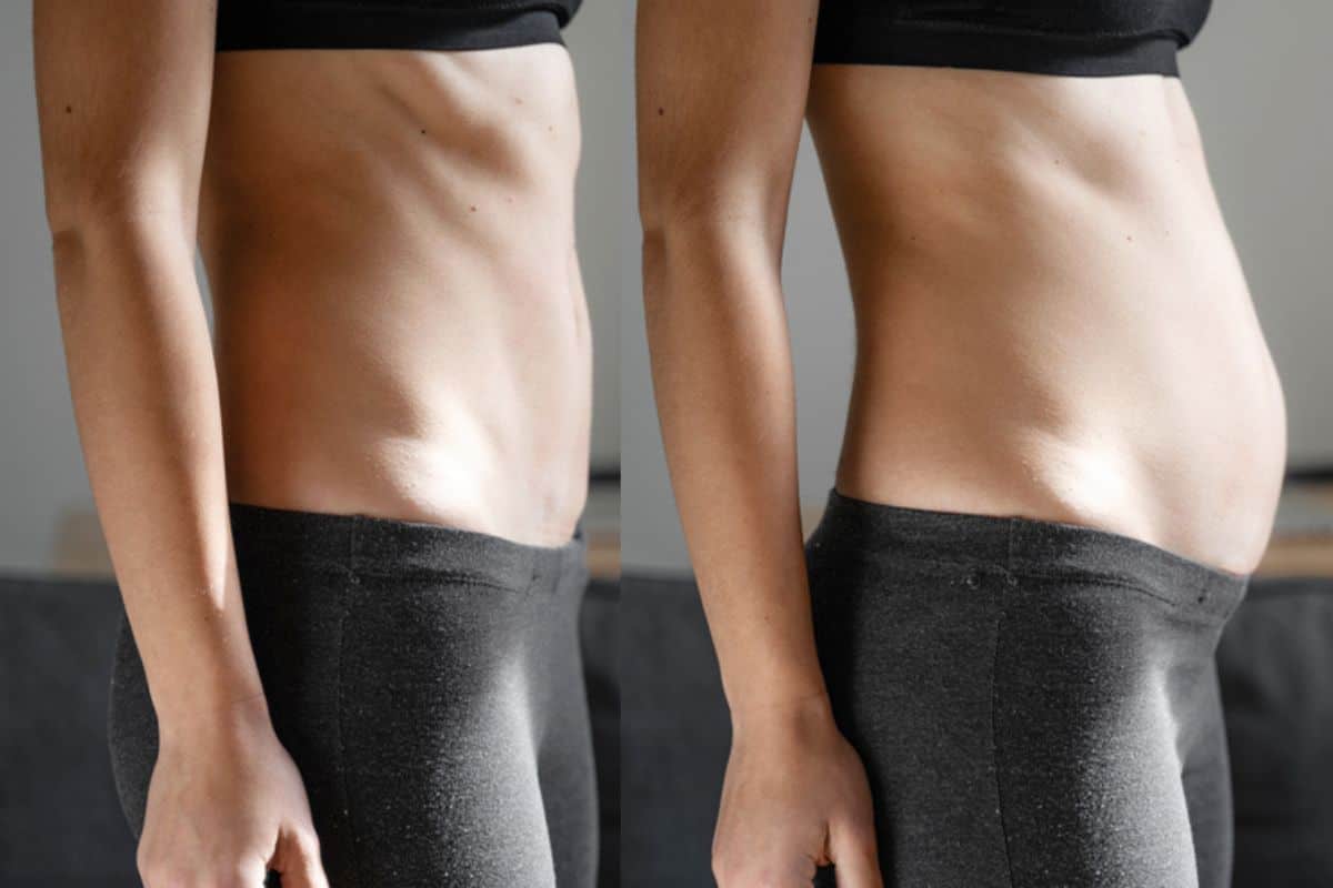 How long does diastasis recti take to improve Neasden?
