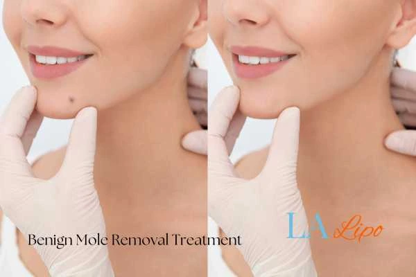 Before-and-after results following benign mole-removal treatment Neasden