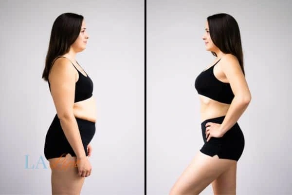 image of woman before and after results of LA-EMS Body Sculpting Neasden to help treat Diastasis recti