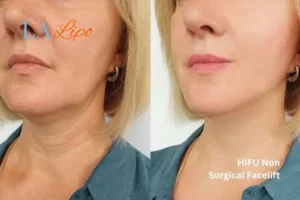 hi-fu for wrinkles Neasden before and after results
