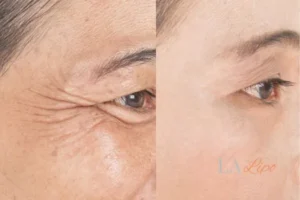 Before and after results of woman - HI-fu wrinkles reduction treatment Neasden