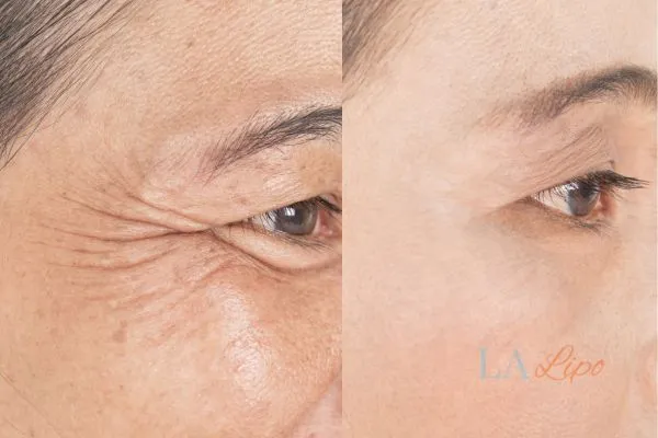 Before and after results of woman - HI-fu wrinkles reduction treatment Neasden