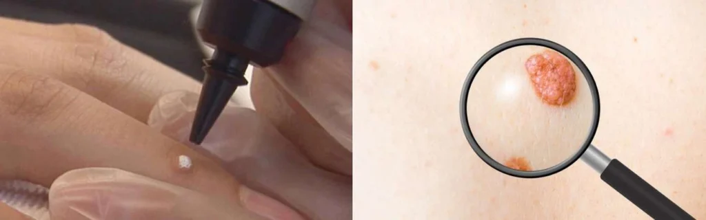 CryoPen practitioner Neasden assessing a benign mole before treatment