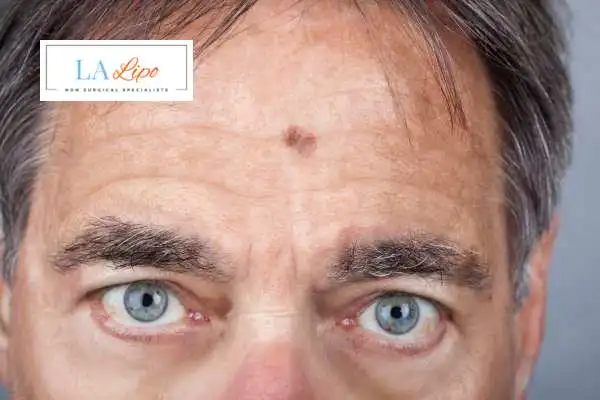 Solar Lentigo Removal Neasden image of man with mark on his forehead