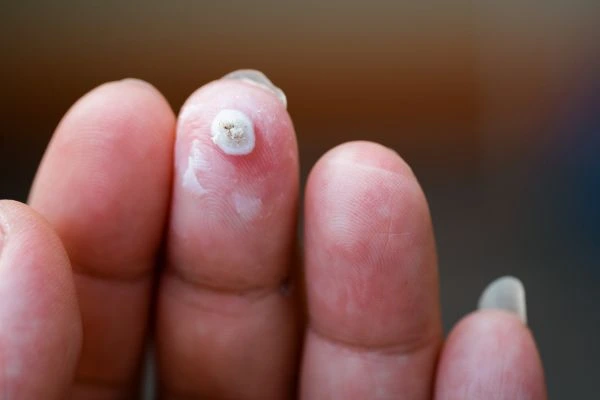 wart on person finger - cryotherapy to treat from LA LIPO Neasden