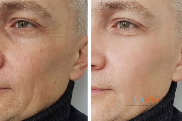 See the amazing results of Morpheus8 Treatment Neasden!