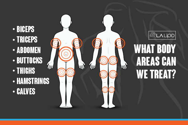 Diagram to show areas you can have LA-EMS Body Sculpting Treatment Neasden