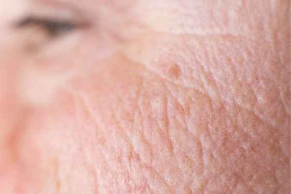 close up picture of a woman's face showing an age spot Neasden