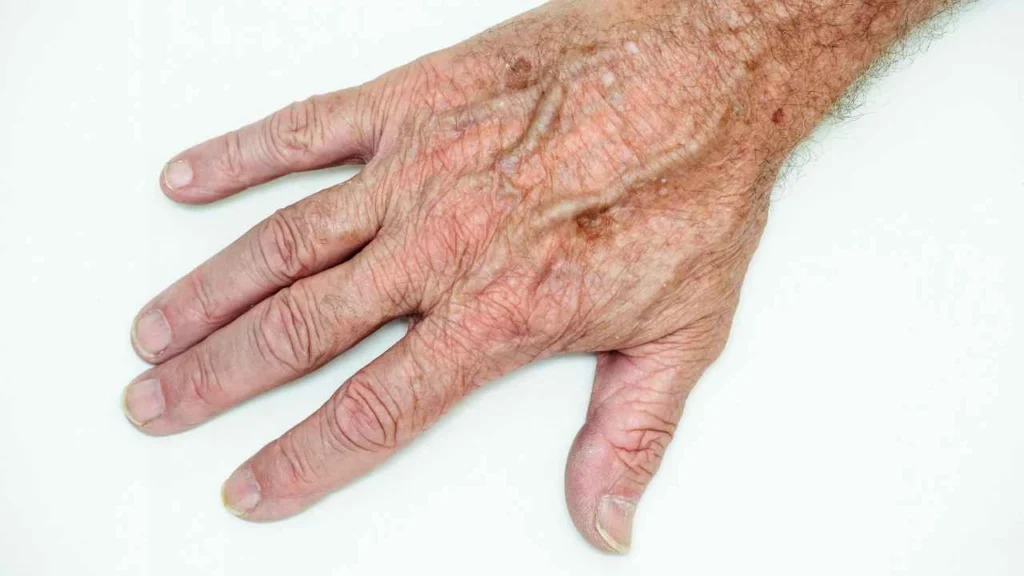 Male hand showing age spot Neasden